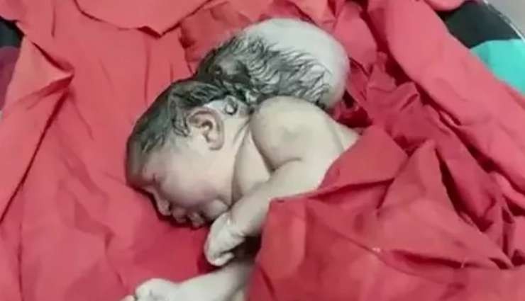Hindistan'da 3 Başlı Bebek Doğdu!