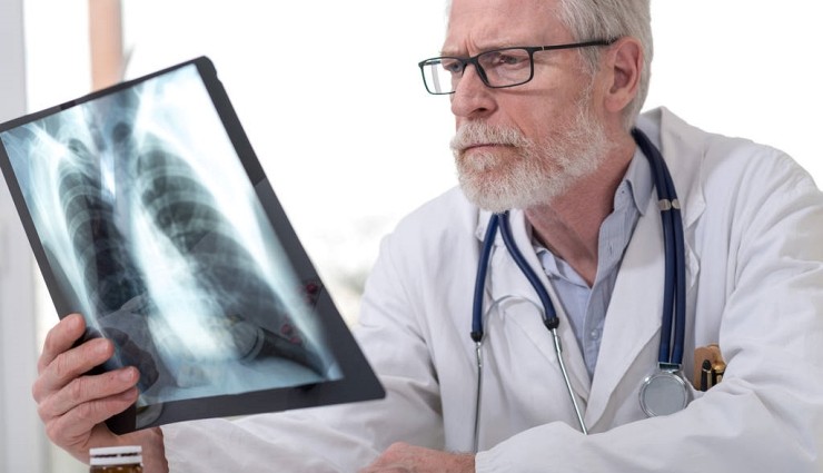 Akciğer Kanseri Tedavisinde Devrim: Cihaz Geliştirildi!